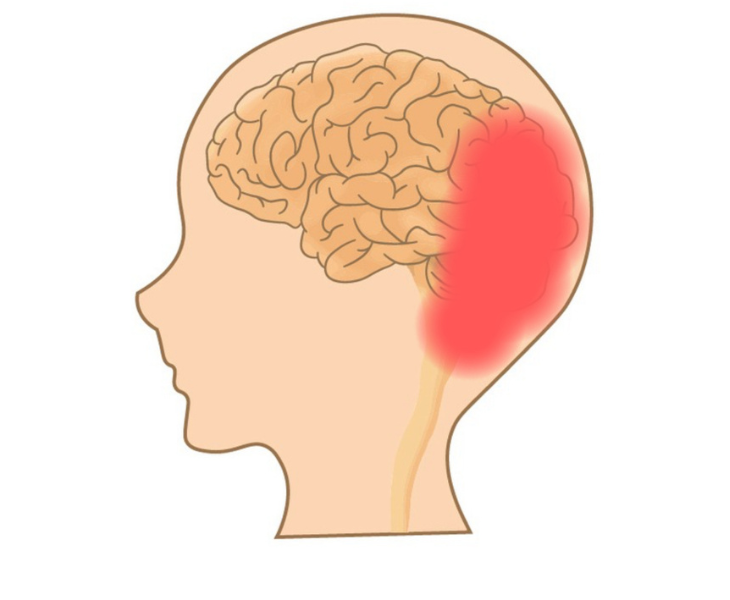 刈谷市で頭痛による後頭部の痛みについて説明している画像。