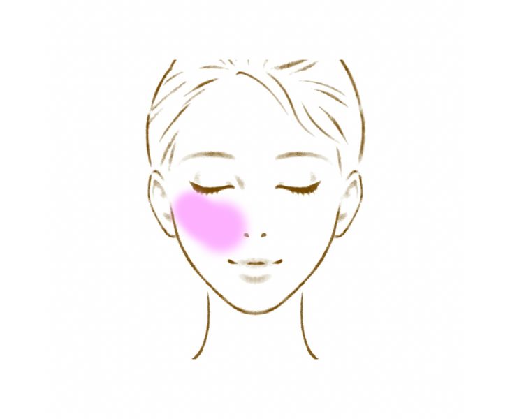 刈谷市で顔のくすみ・むくみに対して施術をしている画像。