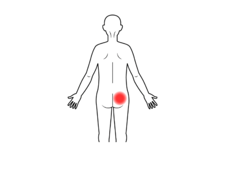 刈谷市でお尻の痛み・前屈み・寝返りで痛みが出る説明をしている画像。