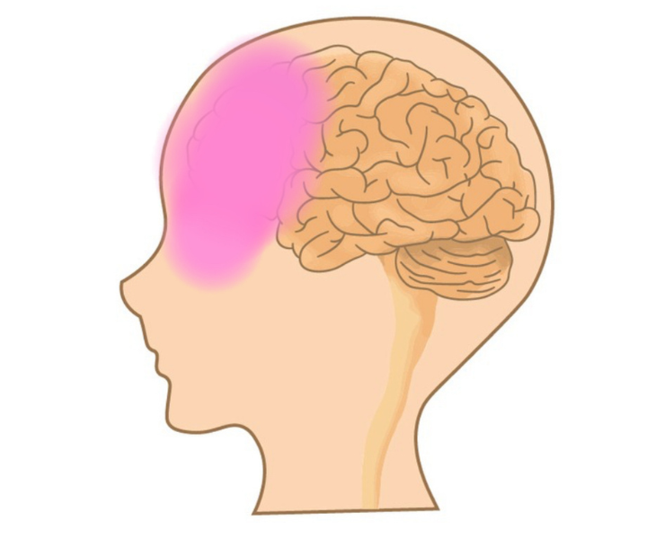 刈谷市で頭痛による前頭部の痛みについて説明している画像。