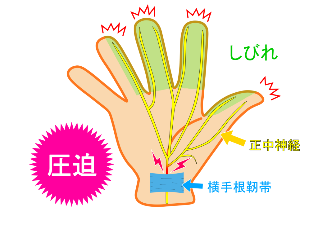 刈谷市で手の痺れについて説明している画像。