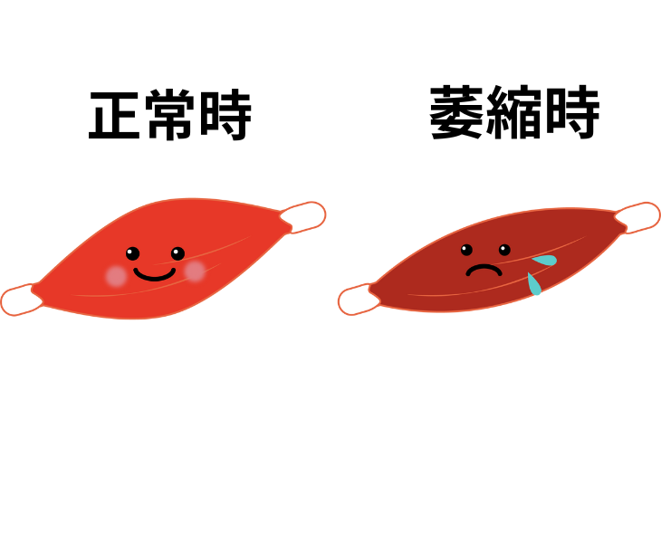 刈谷市で手の筋力低下について説明している画像。