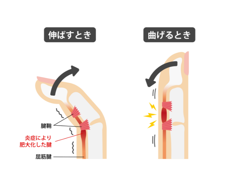 ばね指を説明している画像。