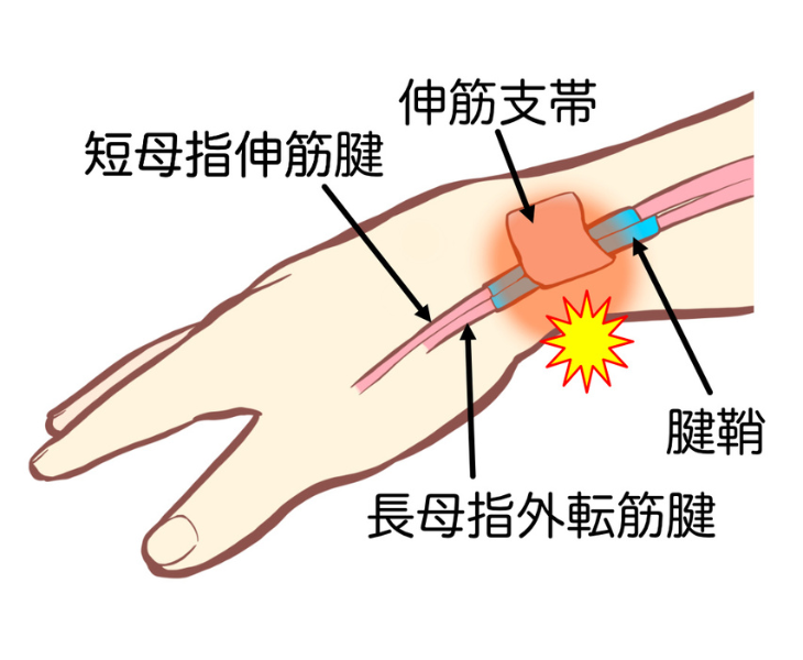 腱鞘炎について説明している画像。