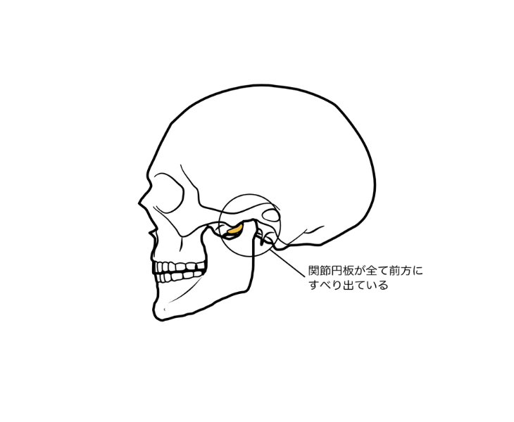 刈谷市で顎関節の関節円板のズレについて説明してる画像。