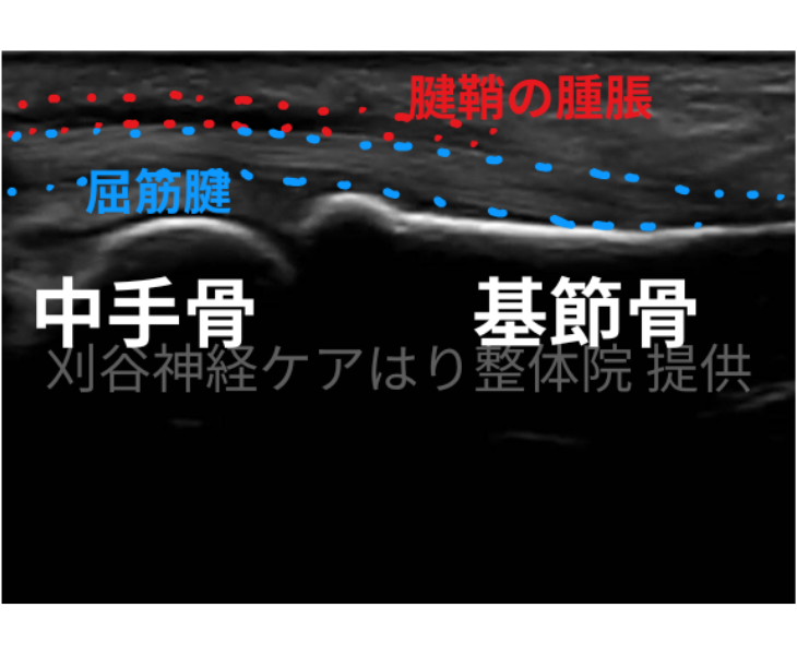 刈谷市で腱鞘炎エコー画像。