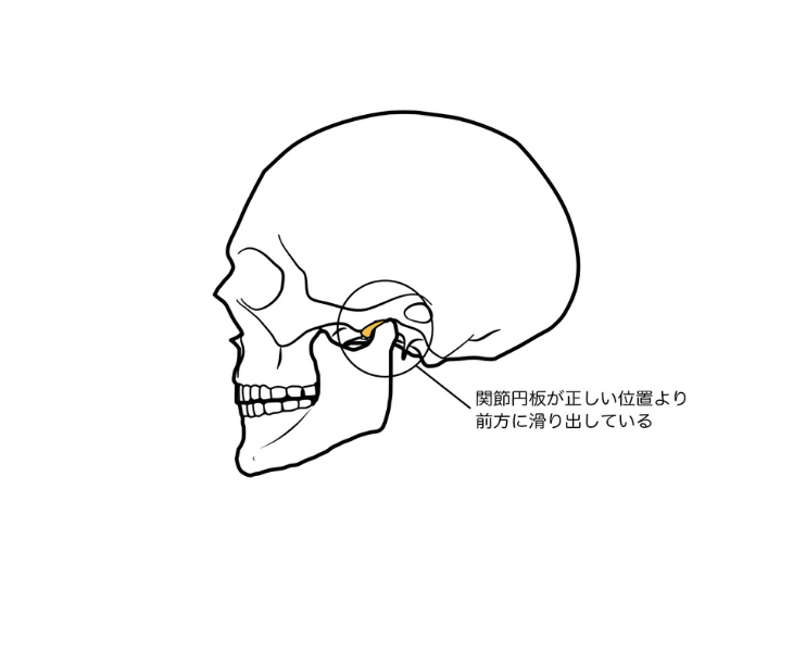 刈谷市で顎関節の関節円板について説明してる画像。